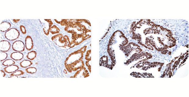 Cell Marque™ IVD antibody staining of colon carcinoma