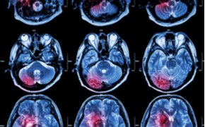 Metabolic Imaging with Hyperpolarization