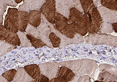 Immunohistochemical staining of skeletal muscle cell (SMC) showing high expression of Troponin t type 1 using Anti-TNNT1 polyclonal Antibody Immunohistochemical staining of skeletal muscle cell (SMC)