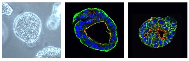 Immunocytochemical characterization of human pancreatic organoids (<a href="/product/mm/scc700">SCC700</a>, PPTO.02). Human PDAC cancer organoids are positive for Cytokeratin 19 (CK19, green), epithelial cell adhesion molecule (EpCAM, green) and Actin (red). Cells counterstained with DAPI (blue). Microscopy images of PDAC organoids. The first image is a contrast microscopy image of the organoid, with one large clear organoid in the center of a grey background. The second image is an immunocytochemical stain of the organoid. CK19 surrounds the cells in the organoid and is shown in green, actin lines the inner ring of the cells of the organoid and is shown in red, and DAPI forms small circles in the middle of the cells and is shown in blue. The third image is an immunocytochemical stain of the organoid; EpCAM lines each cell in the organoid and is shown in green, actin lines the inner ring of the cells of the organoid and is shown in red, and DAPI forms small circles in the middle of the cells and is shown in blue.