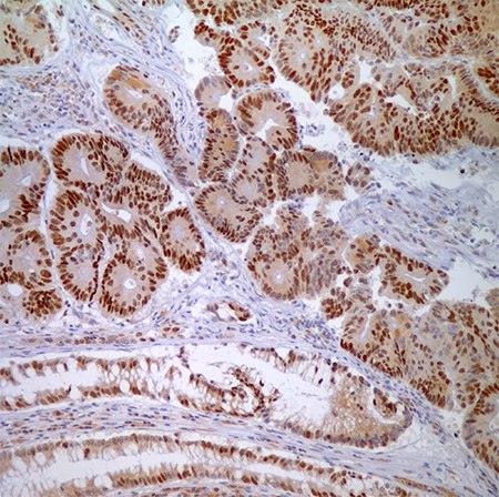 MSH6 (44) - nuclear labeling of adenocarcinoma cells and normal crypt epithelial cells.