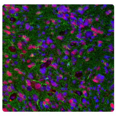 Multiplexed IHC-IF staining of glioblastoma showing ATRX and GFAP immunoreactivity in tumor cells. Anti-ATRX antibody (Product No. AMAB90784) and Anti-GFAP antibody (Product No. AMAB91033) were used.