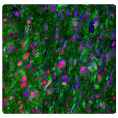 Multiplexed IHC-IF staining of glioblastoma showing ATRX and IDH1 immunoreactivity in tumor cells. Anti-ATRX antibody (Product No. HPA001906) and Anti-IDH1 antibody (Product No. AMAB90578) were used.